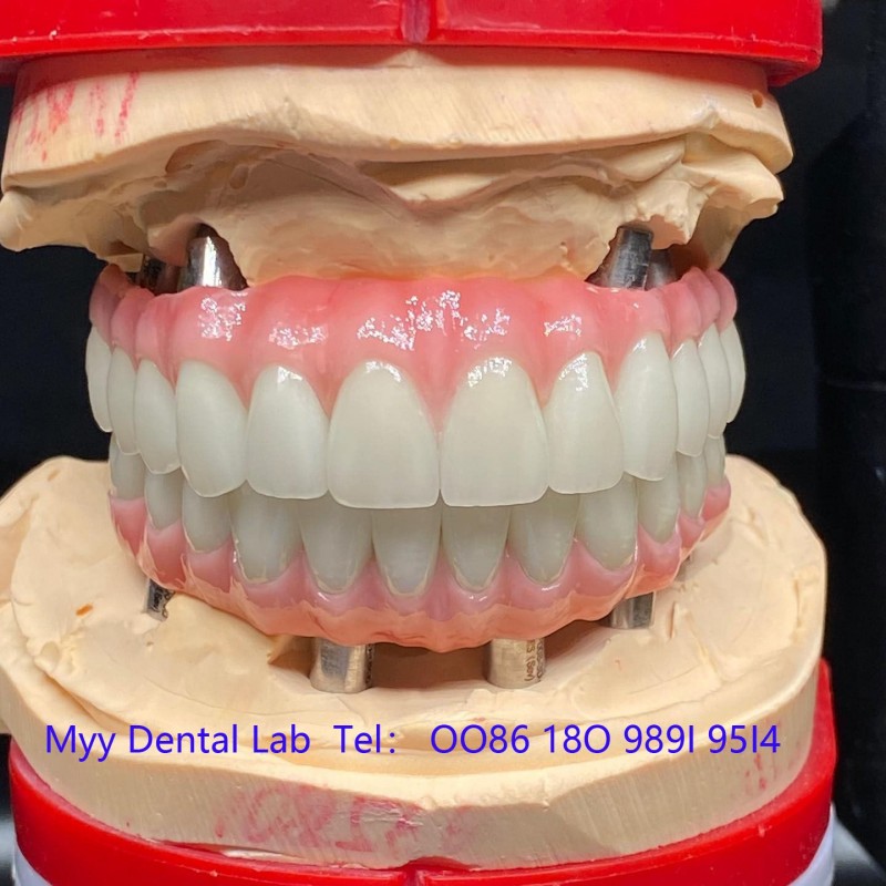 旧金山假牙制作 ，旧金山假牙厂家， 旧金山义齿加工