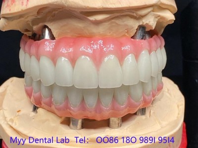 洛杉矶假牙制作 洛杉矶假牙厂家 洛杉矶义齿加工