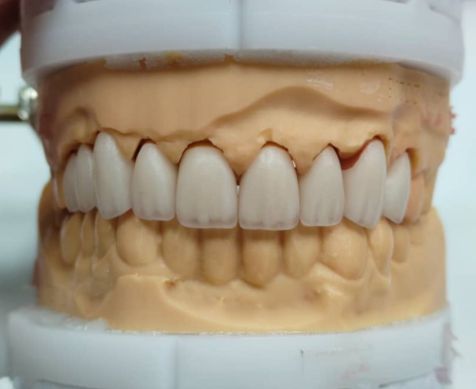 深圳假牙种植牙义齿加工厂家