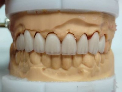 深圳假牙种植牙义齿加工厂家